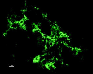 Immunofluorescence – diffuse granular deposits of IgA in the mesangium.