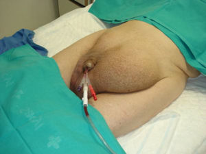Hernia inguinoescrotal bilateral previa a reparación quirúrgica.