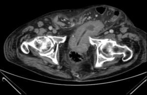 TAC abdominal previa a cirugía.