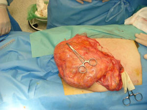 Reparación quirúrgica de la hernia.