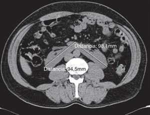 Tomografía abdominal con imagen de riñón en herradura.