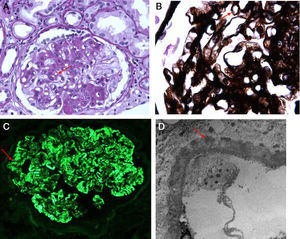 Histopatología renal, en la que se señalan engrosamiento de la membrana basal glomerular (A), espículas subepiteliales con tinción de plata (B), depósito granular de IgG en inmunofluorescencia (C) e inmunocomplejos en membrana basal en microscopia electrónica (D).