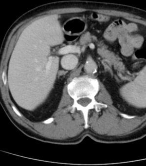 Imagen de TAC abdominal donde se muestra el adenoma suprarrenal.