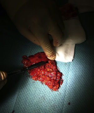 Pieza quirúrgica tras suprarrenalectomía.