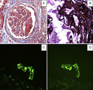 A) Tricrómico de Masson (×40) Se observa ensanchamiento y proliferación mesangial, así como proliferación endocapilar segmentaria, con algunos depósitos fuschinofílicos subendoteliales. B) Metamina de Jones (×100) Se pueden observar defectos de llenado y pequeñas espículas. Los podocitos están prominentes. C) Microscopia por inmunofluoresencia: IgG con patrón granular fino en las membranas basales glomerulares, D) C1q con algunos depósitos subendoteliales.