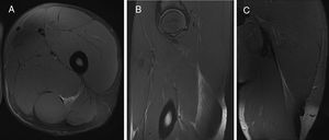 Biceps femoris long head (BFlh) indirect injury (I), located at the proximal third of the thigh (P) and affecting the proximal MTJ (Pp). There is hyperintense focal defect with partial retraction of muscle fibers±intermuscular hemorrhage (G3). This is a first episode (R0). A: Axial T2 weighted fat saturated image showing MTJ destructured with interstitial edema and intermuscular fluid. B: Sagittal T2 weighted fat saturated image showing hyperintense focal defect with partial retraction of muscle fibers. C: Coronal T2 weighted fat saturated image showing intermuscular hemorrhage. Final codification: I Pp G3 R0.