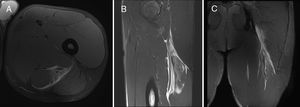 Biceps femoris long head (BFlh) indirect injury (I), located at the proximal third of the thigh and affecting the proximal MTJ (Pp). There is quantifiable gap between muscle fibers in craniocaudal and axial planes; hyperintense focal defect with retraction and intermuscular hemorrhage (G3); there is also a clear transversal free tendon injury tendon showing disruption, retraction and loss of tension, superscript r (Gr3). This is a first episode (R0). A: Axial T2 weighted fat saturated image showing intermuscular hemorrhage surrounding the sciatic nerve, and a free tendon rupture and injury of the semitendinosus MTJ whit interstitial edema. B: Sagittal T2 weighted fat saturated image showing loss of the pennation angle and intermuscular fluid. C: Coronal T2 weighted fat saturated image showing central tendon loss of tension. Final codification: I Pp Gr3 R0.