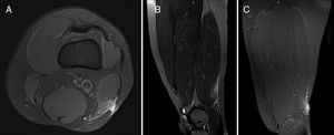 Biceps femoris long head (BFlh) indirect injury (I), located at the distal third of the thigh and affecting the distal MTJ (Dd). There is hyperintense focal defect with partial retraction of muscle fibers±intermuscular hemorrhage (G3); the tendon is affected but there is not disruption/retraction or loss of tension exist (no r superscript). This is a first episode (R0). A: Axial T2 weighted fat saturated image showing distal tendon injury and interstitial edema of the BFlh. B: Sagittal T2 weighted fat saturated image showing tendon injury but without retraction or loss of tension, therefore no superscript (r) should be added to the grade. C: Coronal T2 weighted fat saturated image showing interstitial muscular edema. Final codification: I Dd G3 R0.