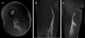 Semimembranosus (SMB) indirect injury (I), located at the proximal third of the thigh and affecting the proximal MTJ (M/Pp). There is quantifiable gap between muscle fibers in craniocaudal and axial planes; hyperintense focal defect with retraction and intermuscular hemorrhage (G3); there is also a clear transversal/longitudinal? tendon injury tendon showing disruption, retraction and loss of tension, superscript r (Gr3). This is a first episode (R0). A: Axial T2 weighted fat saturated image showing MTJ disruption whit interstitial edema; there are chronic changes affecting the tendon. B: Sagittal T2 weighted fat saturated image showing tendon loss of tension, and interstitial edema. C: Coronal T2 weighted fat saturated image showing again the tendon loss of tension and loss of the muscle fibers pennation angle. Final codification: I M/Pp Gr3 R0.