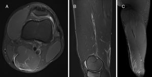 Semimembranosus (SMB) indirect injury (I), located at the distal third of the thigh and affecting the distal MTJ (Dd). There is quantifiable gap between muscle fibers in craniocaudal and axial planes; hyperintense focal defect with retraction and intermuscular hemorrhage (G3). This is a first episode (R0). A: Axial T2 weighted fat saturated image showing MTJ destructuration. B: Sagittal T2 weighted fat saturated image showing MTJ destructuration without loss of tension. C: Coronal T2 weighted fat saturated image showing interstitial edema. Final codification: I Dd G3 R0.