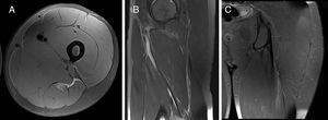 Semitendinosus (SMT) indirect injury (I), located at the proximal third of the thigh and affecting the proximal MTJ (Pp). There is quantifiable gap between muscle fibers in craniocaudal and axial planes; hyperintense focal defect with retraction and intermuscular hemorrhage (G3). This is a first episode (R0). A: Axial T2 weighted fat saturated image showing muscle fibers destructuration and intermuscular fluid. B: Sagittal T2 weighted fat saturated image showing the MTJ injury with small muscle fibers gap. C: Coronal T2 weighted fat saturated image showing interstitial edema. Final codification: I Pp G3 R0.