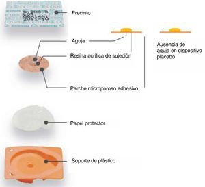 Dispositivo empleado para los grupos de acupuntura auricular verdadera y acupuntura auricular no específica (New Pyonex) y para el grupo de acupuntura auricular placebo.