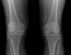Radiografía simple en proyección anteroposterior en bipedestación. Se identifican calcificaciones en cartílago articular, meniscos laterales y mediales de ambas rodillas.