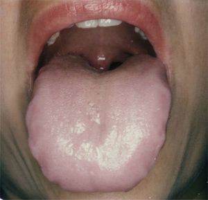 Fotografía oral, visión craneal. Se objetiva una lengua hinchada con bordes dentales marcados y capa lingual blanquecina.