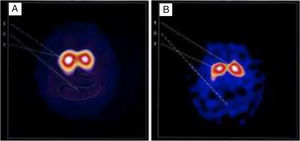 Imágenes del cerebro de un paciente modelo tomadas mediante SPECT (tomografía computarizada por emisión de fotón único) con DaTSCAN© en las que se observan la activación de los receptores dopaminérgicos del cuerpo estriado (una región subcortical de los ganglios basales) antes (A) y después (B) de la terapia con acupuntura auricular permanente. A: se observa que el putamen es completamente inexistente (falta la característica forma de mariposa); tomada en diciembre 2006. B: la parte izquierda del putamen ya es totalmente normal y la parte derecha está alcanzando la normalidad; tomada en julio 2007.