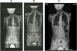 Imágenes radiológicas del paciente L.A. de 2014 (A), 2015 (B) y 2017 (C).