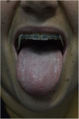 Características de la lengua de la paciente.