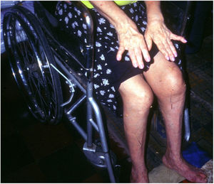 Fotografía de la cuarta paciente (E.O. de F.) en la que se observa a la paciente en silla de ruedas por avanzada artritis de las caderas.