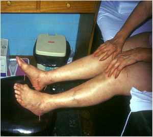 Fotografía de la octava paciente (M.F.) en la que se observa la desviación cubital de las articulaciones de manos y pies.