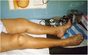 Fotografía de la décima paciente (G.F. de V.) en la que se observa cirugía de la rodilla, frecuente en la artritis.