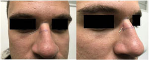Patient treated with nasal microsystem.