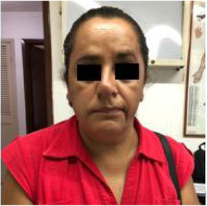 Aspecto de la paciente después de la primera sesión de electroacupuntura. Publicada previa autorización de la paciente.