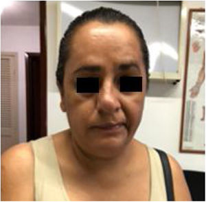 Aspecto de la paciente después de la segunda sesión de electroacupuntura. Publicada previa autorización de la paciente.
