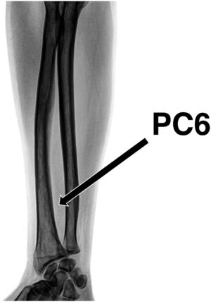Pericardium 6 (Neiguan) acupoint.