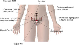 Disposición de los puntos que se utilizaron en el caso clínico. Para la técnica de acupuntura geométrica se consideró una matriz con cuadrículas de proporción 1 cun, considerando 5 cun desde el ombligo hasta la sínfisis del pubis. En verde se muestra el punto central como referencia y en rojo los puntos adyacentes.