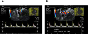 Flujometría Doppler registrada en tiempo real A) a los 8 días previos al tratamiento con acupuntura y B) a los 14 días posteriores al tratamiento.