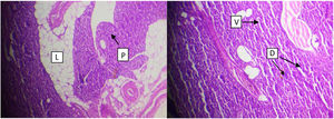 Left: lipid deposition in the cells o f pancreas tissue (L) Atrophy the acini (p). Right: destruction the secretory acini. (D) vacoulation between the pancreatic tissues (V), (H&E 400X).