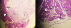 Left: lipid deposition in the same regions (L) and other regions are normal. Right: little amount of distraction (D) normal acini and pancreatic tissue (N). H&E 200X.