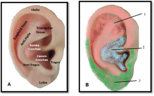 Schematic illustration about the human auricle anatomy. Legend: (A) and auricular innervation (B), 1: pink area exemplifies the trigeminal, and auriculotemporal nerve innervation; 2: includes the auricular branch of the vagus nerve (blue shading); 3: Green area is represented by the greater auricular nerve, desenvolved from Liu C et al., (2020) and Terry Oleson (2014) works. (For interpretation of the references to color in this fig. legend, the reader is referred to the web version of this article.)