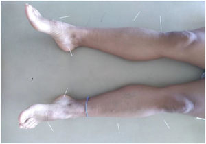 Puntos bilaterales en miembros inferiores: B 4 (Gongsun), H 3 (Taichong), E 40 (Fenglong) y VB 34 (Yanglingquan). Elaboración propia. Universidad Estatal Del Valle De Toluca, 2023.