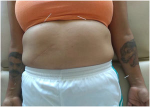 Puntos bilaterales en los miembros superiores y el abdomen: PC 5 (Jiangshi), H 14 (Qimen). Elaboración propia. Universidad Estatal Del Valle De Toluca, 2023.