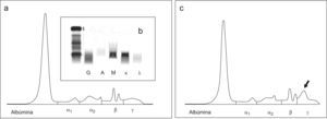 a) Proteinograma del suero del paciente del caso 1 antes de ser tratado con β-mercaptoetanol. b) Inmunofijación del suero del paciente del caso 1. c) Proteinograma del suero del paciente del caso 1 después de ser tratado con β-mercaptoetanol.