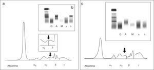 a) Proteinograma del suero del paciente del caso 2; en el recuadro pequeño se muestra una ampliación de la zona comprendida entre α2 y β b) Inmunofijación del suero del paciente del caso 2. c) Proteinograma e inmunofijación de una muestra de suero con una concentración alta de bilirrubina.