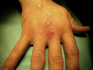 Bultomas con lesiones nodosas y eritematosas de patrón esporotricoide en el dorso de la mano del paciente.