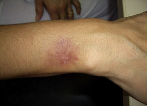 Lesión tipo absceso no adherido a planos profundos en el dorso de la mano de la paciente.