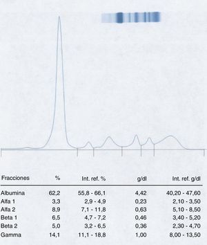 Electroforesis capilar de zona del suero del paciente 1 realizada 13 días después de la primera extracción en la que ya no aparece el posible pico monoclonal.