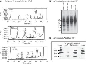 Análisis de las isoformas de la N-glicoproteína transferrina y de la O-glicoproteína lipoproteína apoC3 en suero para la detección de defectos congénitos de glicosilación. A) Perfil de las isoformas de la transferrina separadas y cuantificadas por HPLC-Variant. La isoforma mayoritaria en suero control es la tetrasialilada (T4); se observa un perfil alterado tipo 1, en un paciente con PMM2-CDG, con aumentos de las isoformas hipoglicosiladas: asialilada (T0) y disialilada (T2) y de tipo 2 en un paciente con PGM-CDG, en donde se observan aumentos de las isoformas: asialilada (T0), monosialilada (T1), disialilada (T2) y trisialilada (T3). En ambos casos se observa la disminución de la isoforma mayoritaria T4. B) Análisis por isoelectroenfoque de la transferrina, en este caso las isoformas se separan por su punto isoeléctrico en gradiente de pH. Se observan las bandas patológicas en los pacientes con PMM2-CDG (T0 y T2) y PGM-CDG (T0, T1, T2 y T3, respectivamente). C) Análisis por isolectroenfoque de la apoC3, las isoformas también se separan en función de su punto isoeléctrico en un gradiente de pH. Los carriles centrales corresponden a dos pacientes con un defecto combinado en la N- y O-glicosilación de proteínas. En un caso se observa aumento de la isoforma asialilada (ASA) y desaparición de las bandas correspondientes a las formas disialilada (DSA) y monosialilada (MSA) y en el otro aumento de la isoforma MSA y fuerte disminución de la DSA de la apoC3.