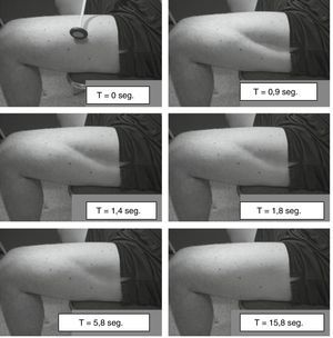 Miotonía por percusión del muslo. Se utilizó un martillo de reflejos para golpear el extremo distal del músculo vasto lateral y esto produjo una contracción del músculo que persistió durante varios segundos. Tomada de Lossin et al.14 con permiso del editor.
