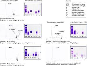 Electroforesis en suero (SPE) e inmunofijación en suero (IFE) de los pacientes con mieloma múltiple (MM) IgD.