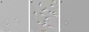 Espermatozoides vivos observados a una magnificación 400X para ICSI A) y magnificación >6000X para IMSI B) y C). Presencia de vacuolas en B). Espermatozoide sin vacuolas en C). Tomado de Marci et al.18.