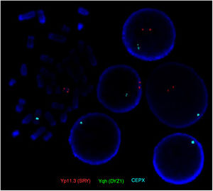 Imagen FISH (hibridación in situ fluorecescente) donde se observa una señal de hibridación para la sonda centromérica del cromosoma X (CEPX) color azul, dos señales de hibridación correspondientes al gen SRY (Yp11.3) color rojo. (El color de esta figura solo puede apreciarse en la versión electrónica del artículo).