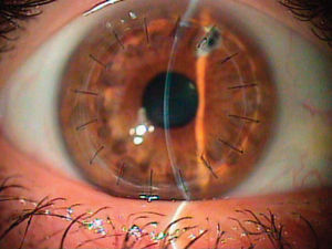 A postoperative picture of the eye, 9 months after undergoing penetrating keratoplasty.