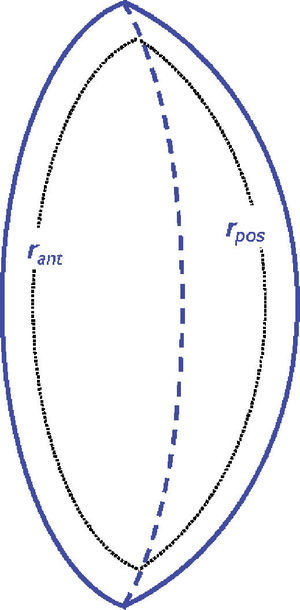 “Doublet” lens model. The central interface is the locus of the intersections of anterior and posterior parts (hemispheres) of isoindical surfaces.