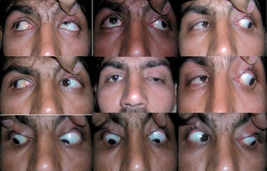 Moderate ptosis in a left eye with elevation deficit.