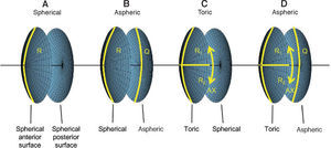 Types of customized IOLs. Depending on the complexity of the lens one or more parameters need to be calculated, resulting in a one- or a multi-dimensional optimization procedure. The degrees of freedom of the biconic anterior and posterior surfaces are shown for A. A spherical IOL, B. An aspheric IOL, C. A toric IOL and D. A toric aspheric IOL.