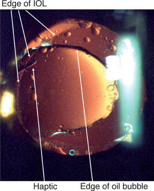 Colour photograph of the anterior chamber of the eye showing the intra-ocular lens and revealing the presence of a silicone oil bubble.